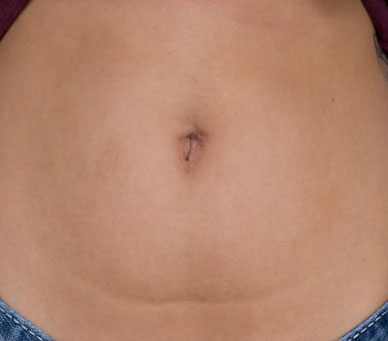 Image of barely visible umbilical scar